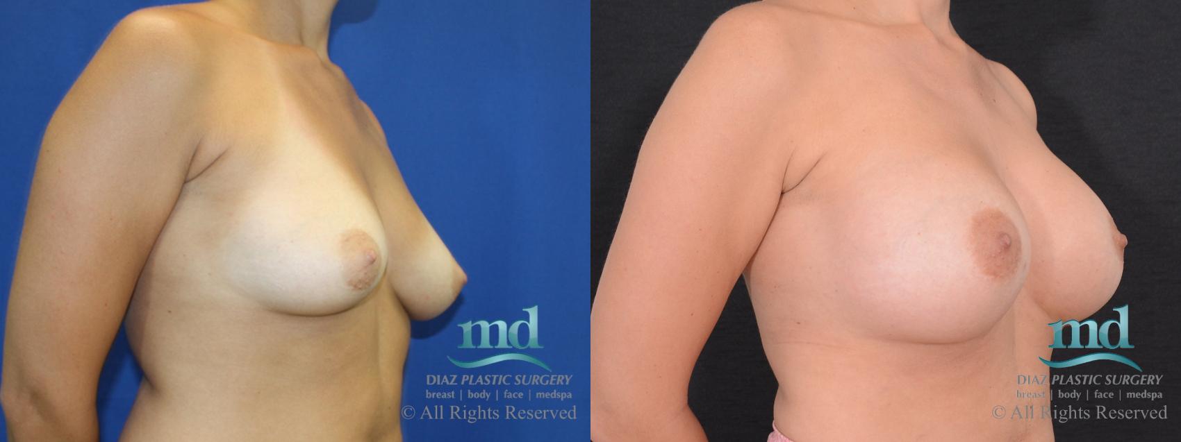 Before & After Breast Augmentation Case 41 View #2 View in Melbourne, FL