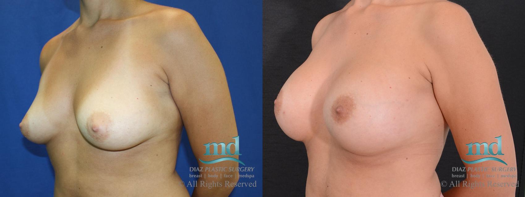 Before & After Breast Augmentation Case 41 View #4 View in Melbourne, FL