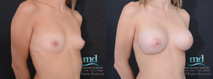 Before & After Breast Augmentation Case 42 View #2 View in Melbourne, FL