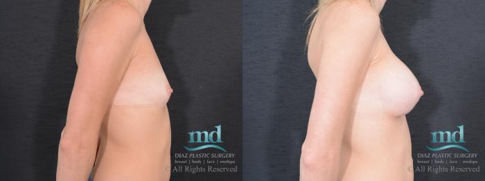 Before & After Breast Augmentation Case 42 View #3 View in Melbourne, FL