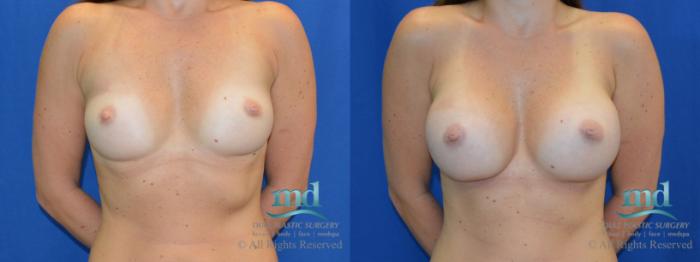 Before & After Breast Augmentation Case 43 View #1 View in Melbourne, FL