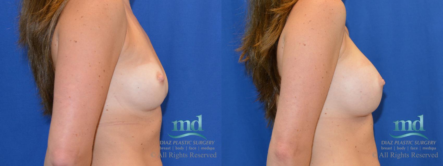 Before & After Breast Augmentation Case 43 View #2 View in Melbourne, FL