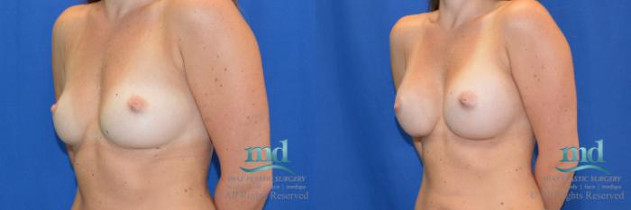 Before & After Breast Augmentation Case 43 View #3 View in Melbourne, FL