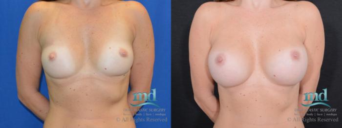 Before & After Breast Augmentation Case 44 View #1 View in Melbourne, FL