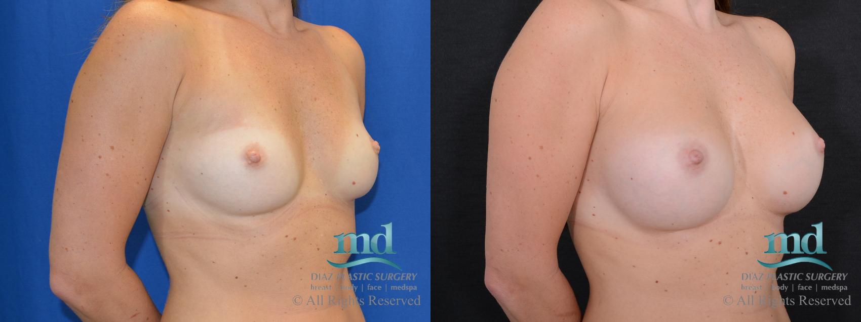 Before & After Breast Augmentation Case 44 View #2 View in Melbourne, FL