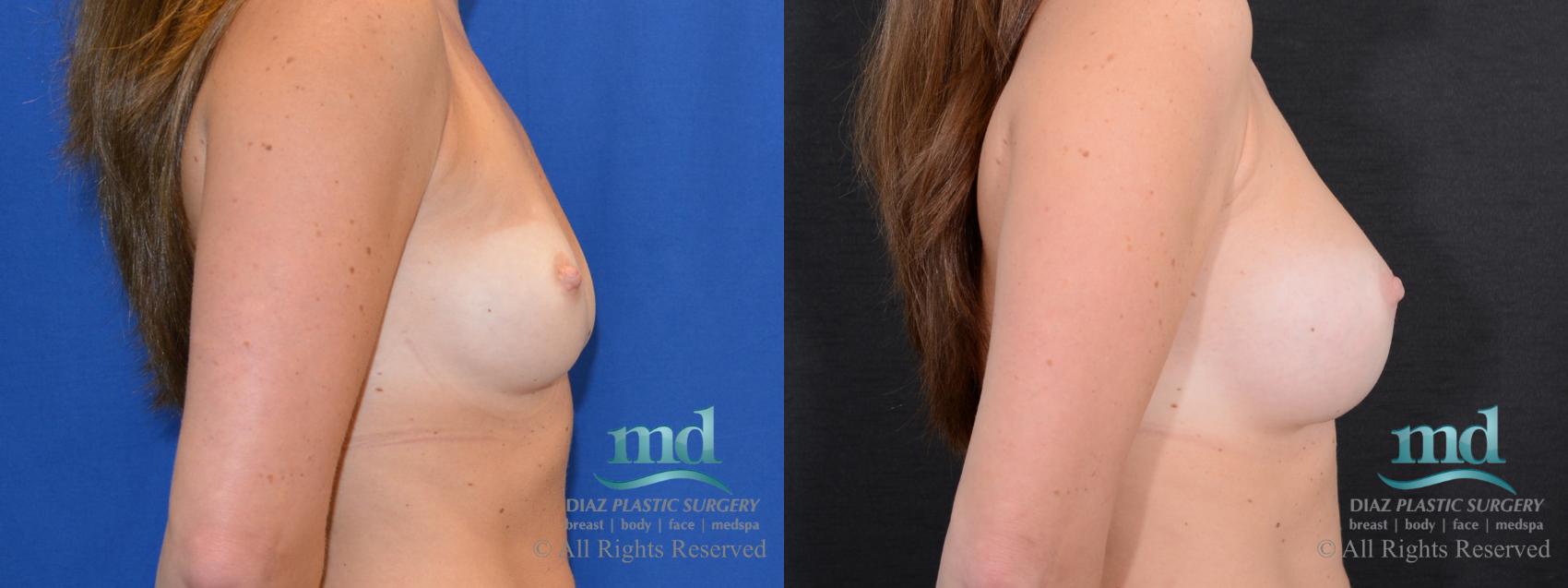 Before & After Breast Augmentation Case 44 View #3 View in Melbourne, FL