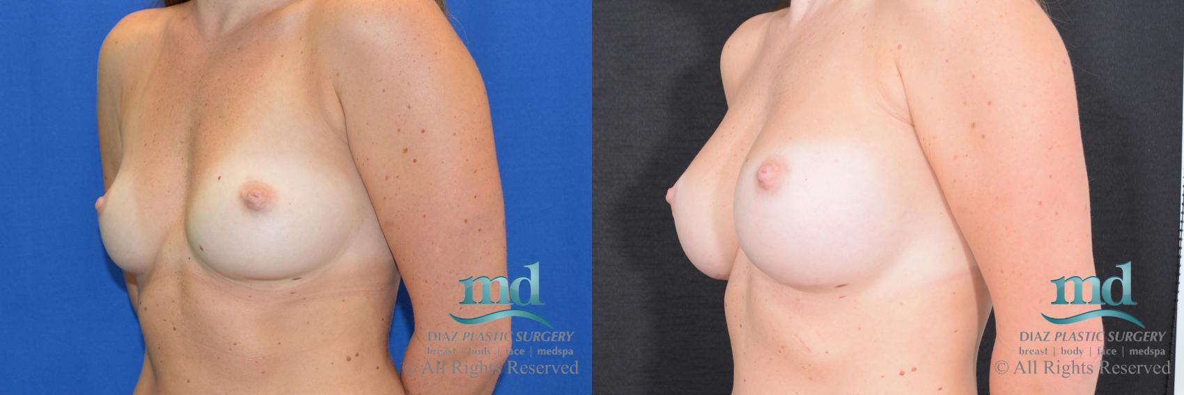 Before & After Breast Augmentation Case 44 View #4 View in Melbourne, FL