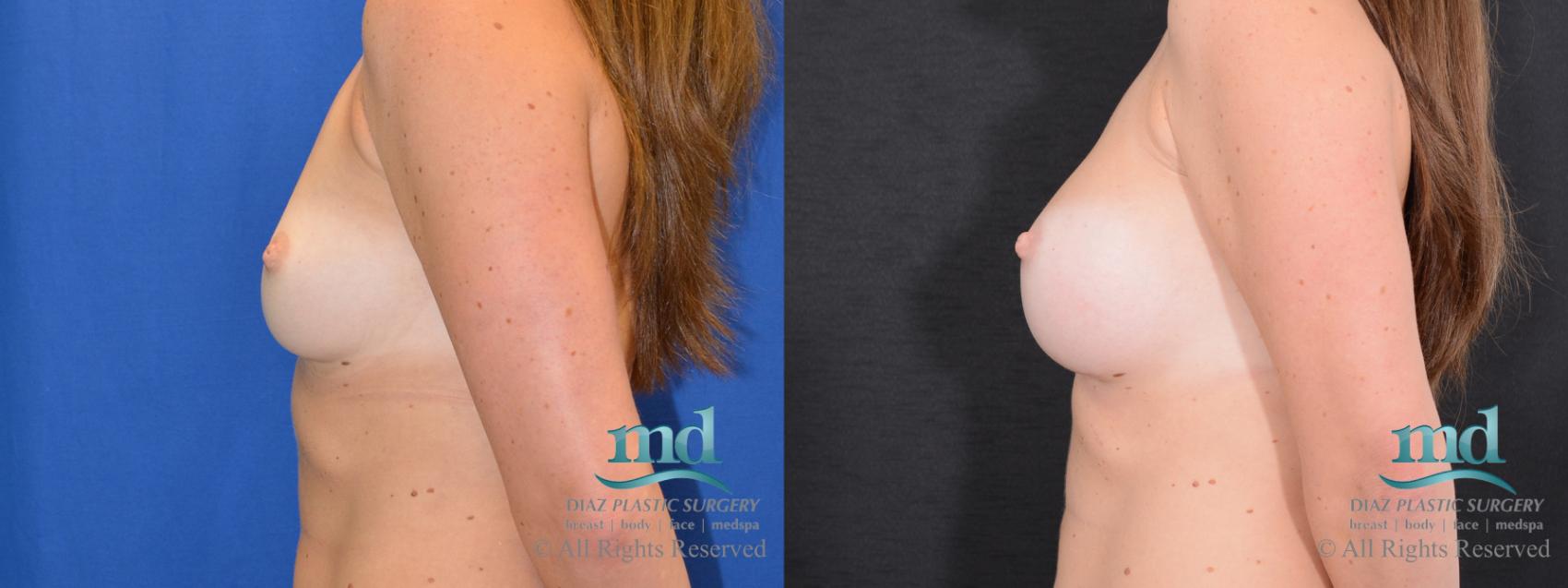 Before & After Breast Augmentation Case 44 View #5 View in Melbourne, FL