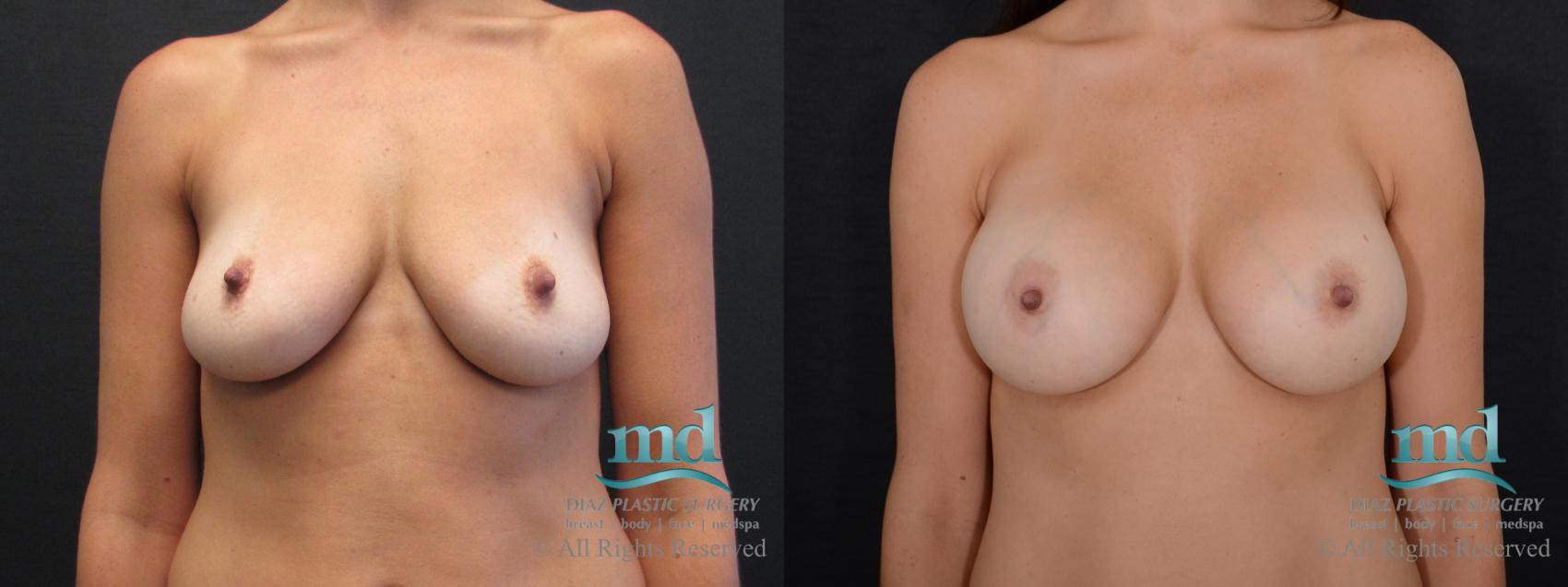 Before & After Breast Augmentation Case 45 View #1 View in Melbourne, FL