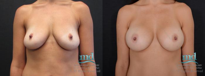 Before & After Breast Augmentation Case 45 View #1 View in Melbourne, FL