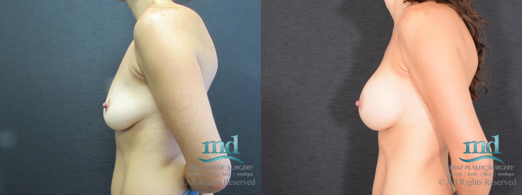 Before & After Breast Augmentation Case 45 View #5 View in Melbourne, FL