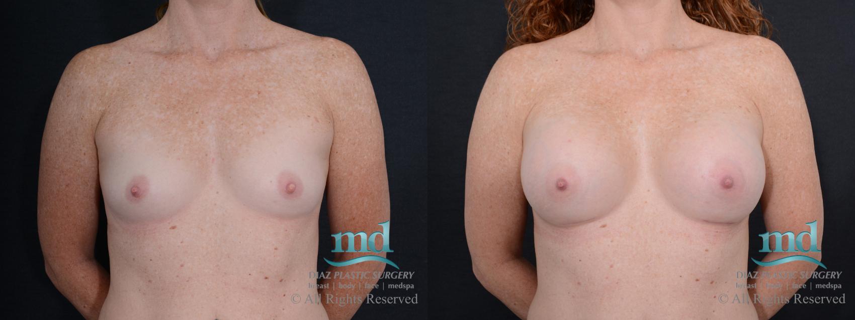 Before & After Breast Augmentation Case 46 View #1 View in Melbourne, FL