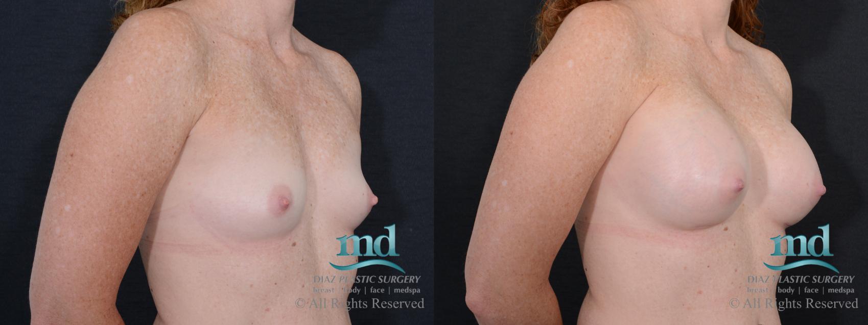Before & After Breast Augmentation Case 46 View #2 View in Melbourne, FL