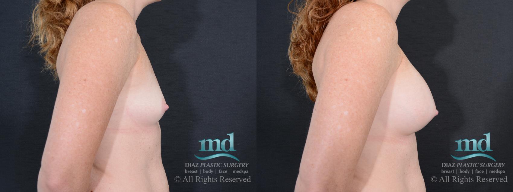 Before & After Breast Augmentation Case 46 View #3 View in Melbourne, FL