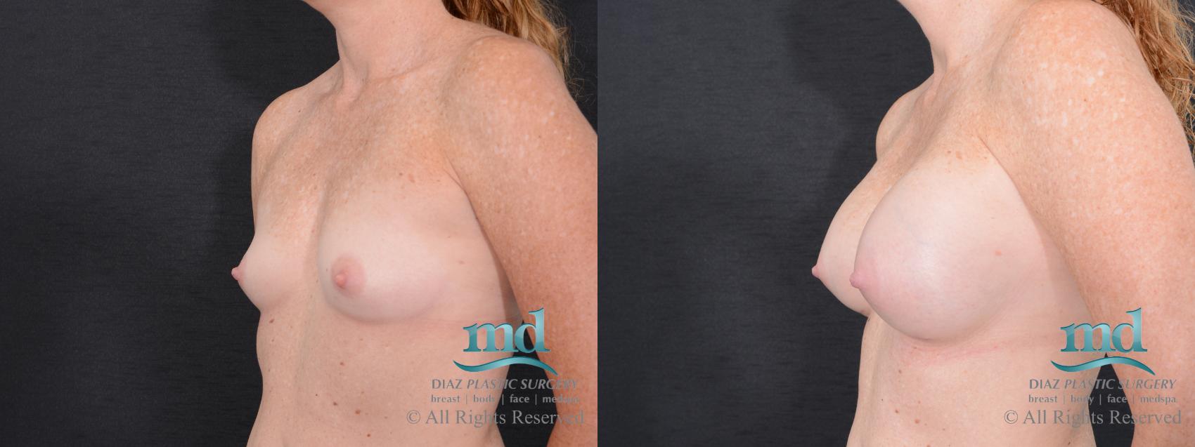 Before & After Breast Augmentation Case 46 View #4 View in Melbourne, FL