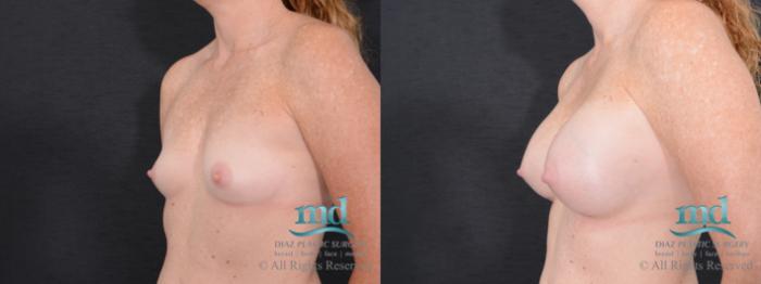 Before & After Breast Augmentation Case 46 View #4 View in Melbourne, FL