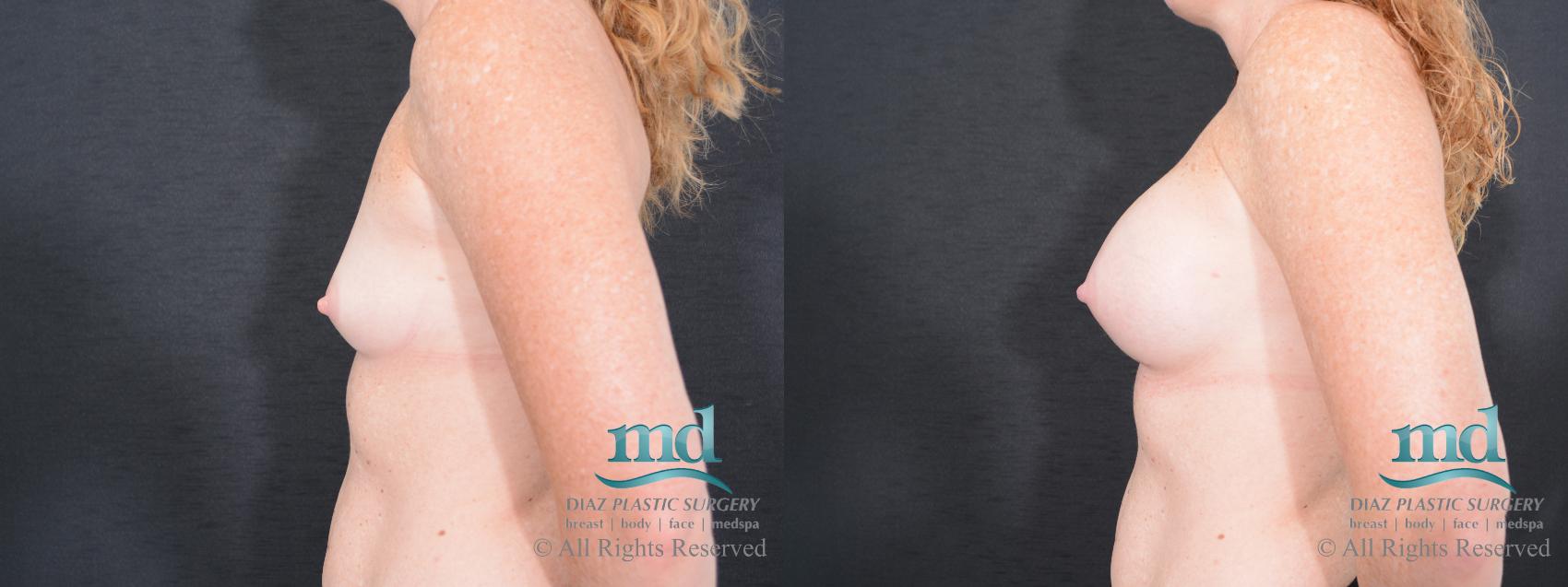 Before & After Breast Augmentation Case 46 View #5 View in Melbourne, FL