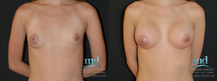 Before & After Breast Augmentation Case 47 View #1 View in Melbourne, FL