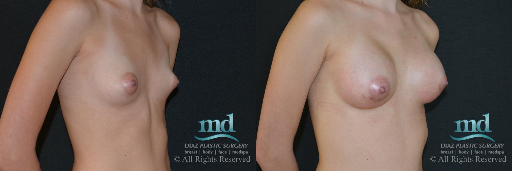 Before & After Breast Augmentation Case 47 View #2 View in Melbourne, FL