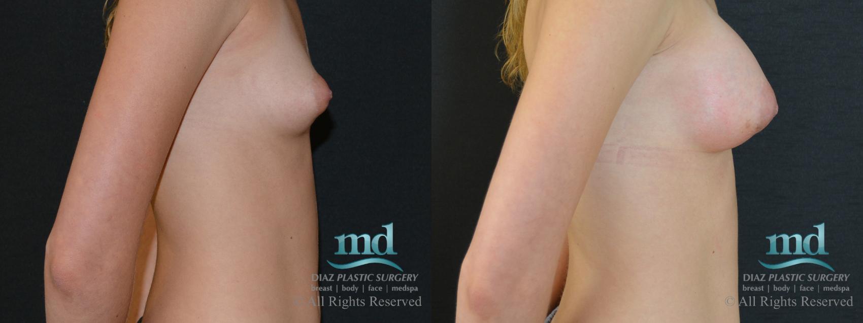Before & After Breast Augmentation Case 47 View #3 View in Melbourne, FL