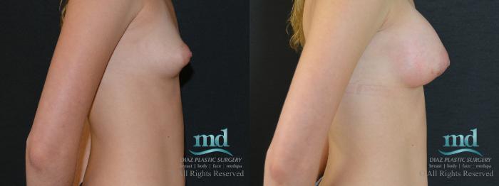 Before & After Breast Augmentation Case 47 View #3 View in Melbourne, FL