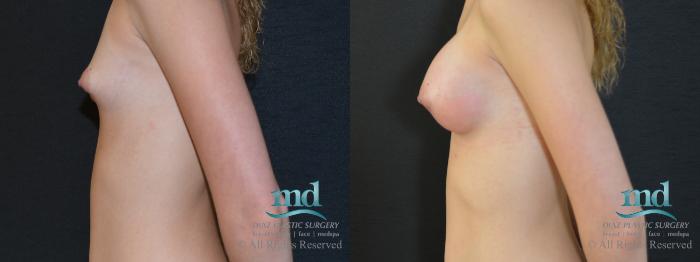 Before & After Breast Augmentation Case 47 View #5 View in Melbourne, FL