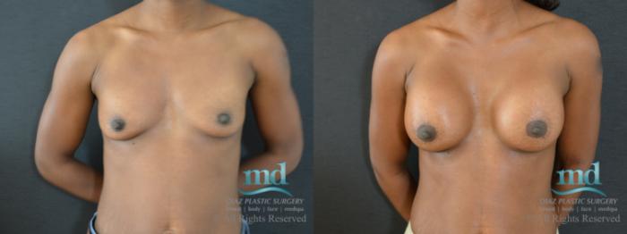 Before & After Breast Augmentation Case 48 View #1 View in Melbourne, FL