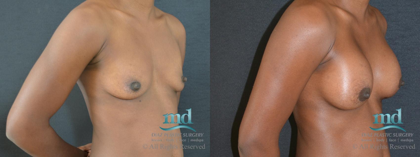Before & After Breast Augmentation Case 48 View #2 View in Melbourne, FL