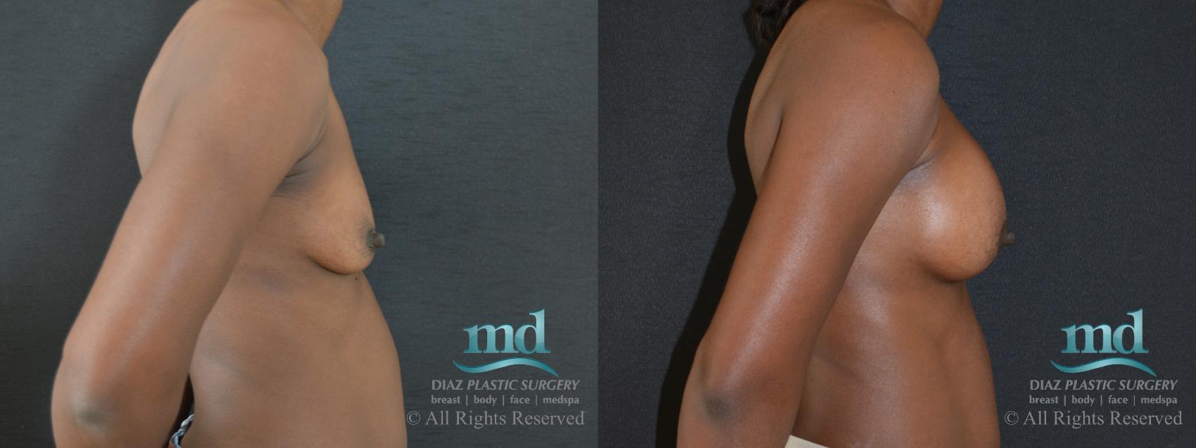 Before & After Breast Augmentation Case 48 View #3 View in Melbourne, FL