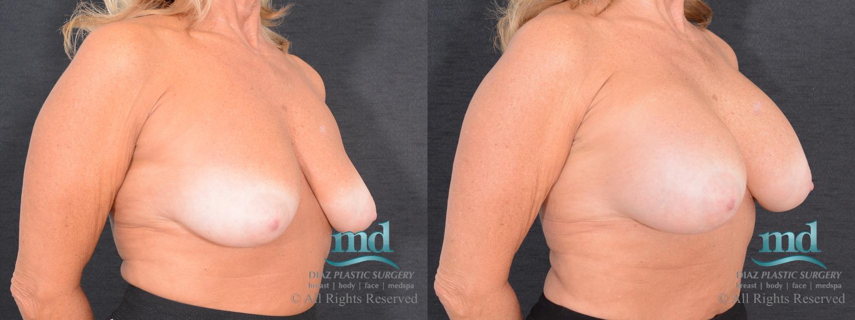 Before & After Breast Augmentation Case 49 View #2 View in Melbourne, FL