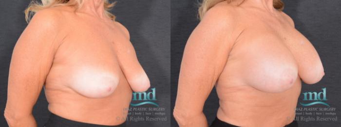 Before & After Breast Augmentation Case 49 View #2 View in Melbourne, FL