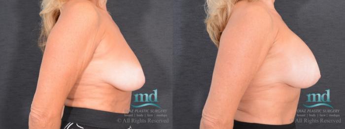 Before & After Breast Augmentation Case 49 View #3 View in Melbourne, FL