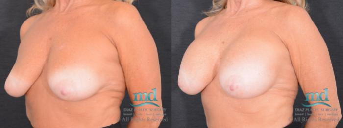 Before & After Breast Augmentation Case 49 View #4 View in Melbourne, FL