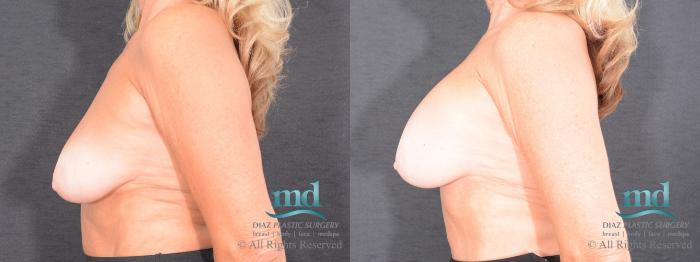 Before & After Breast Augmentation Case 49 View #5 View in Melbourne, FL