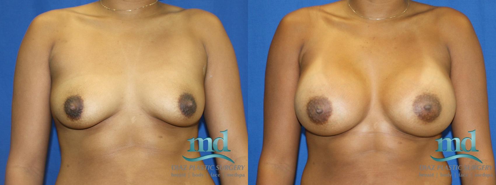 Before & After Breast Augmentation Case 5 View #1 View in Melbourne, FL