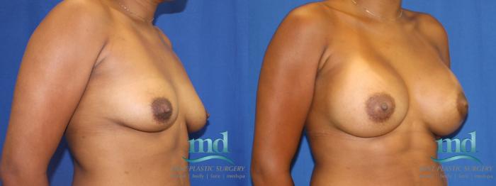 Before & After Breast Augmentation Case 5 View #2 View in Melbourne, FL