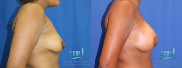 Before & After Breast Augmentation Case 5 View #3 View in Melbourne, FL