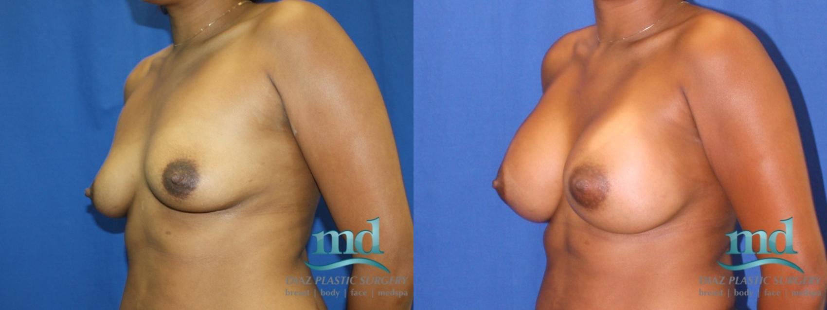 Before & After Breast Augmentation Case 5 View #4 View in Melbourne, FL