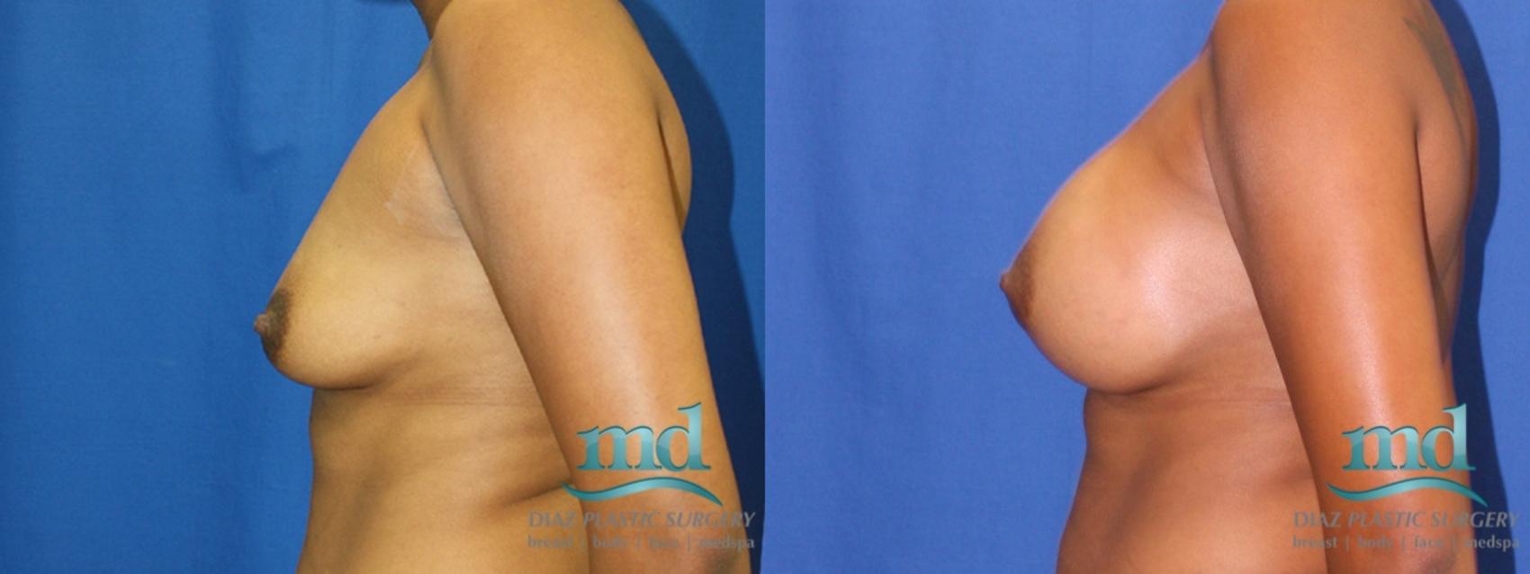 Before & After Breast Augmentation Case 5 View #5 View in Melbourne, FL
