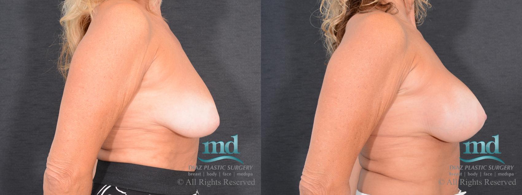 Before & After Breast Augmentation Case 50 View #3 View in Melbourne, FL
