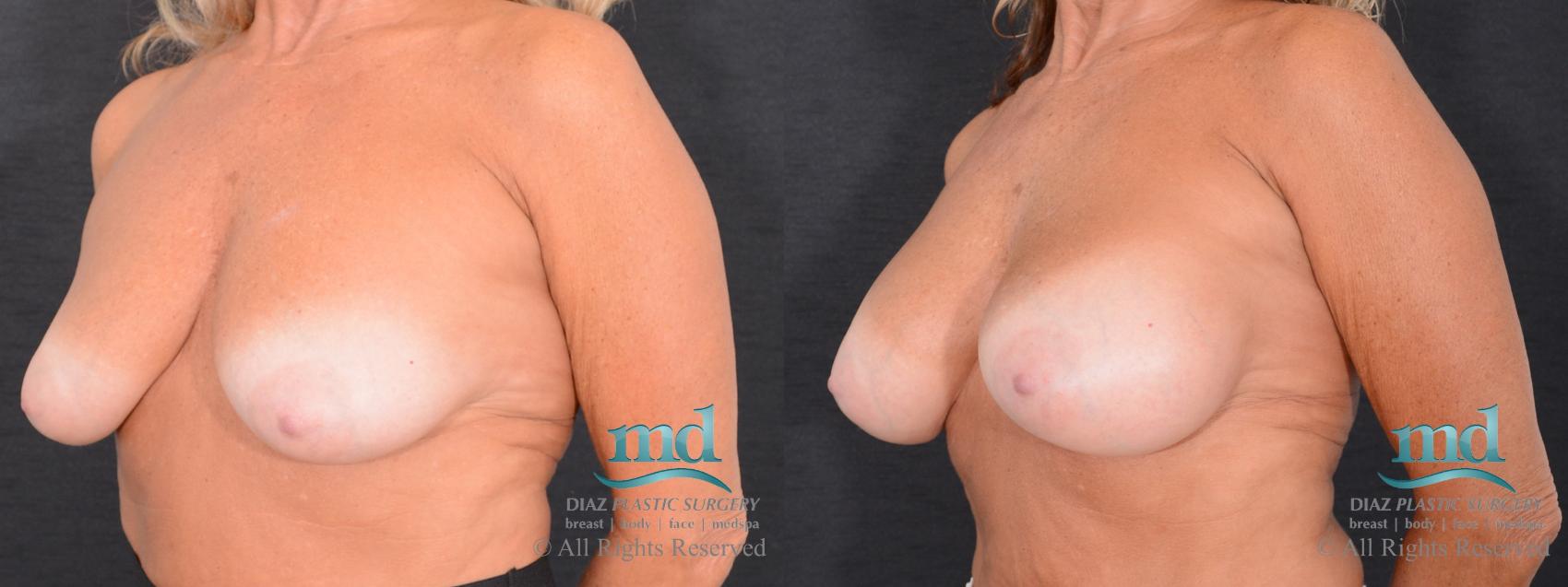 Before & After Breast Augmentation Case 50 View #4 View in Melbourne, FL