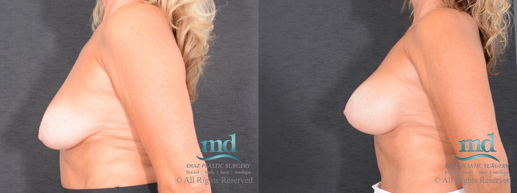 Before & After Breast Augmentation Case 50 View #5 View in Melbourne, FL