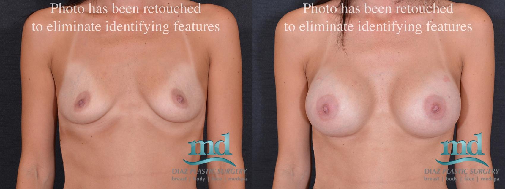 Before & After Breast Augmentation Case 52 View #1 View in Melbourne, FL