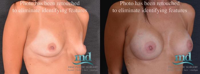Before & After Breast Augmentation Case 52 View #2 View in Melbourne, FL