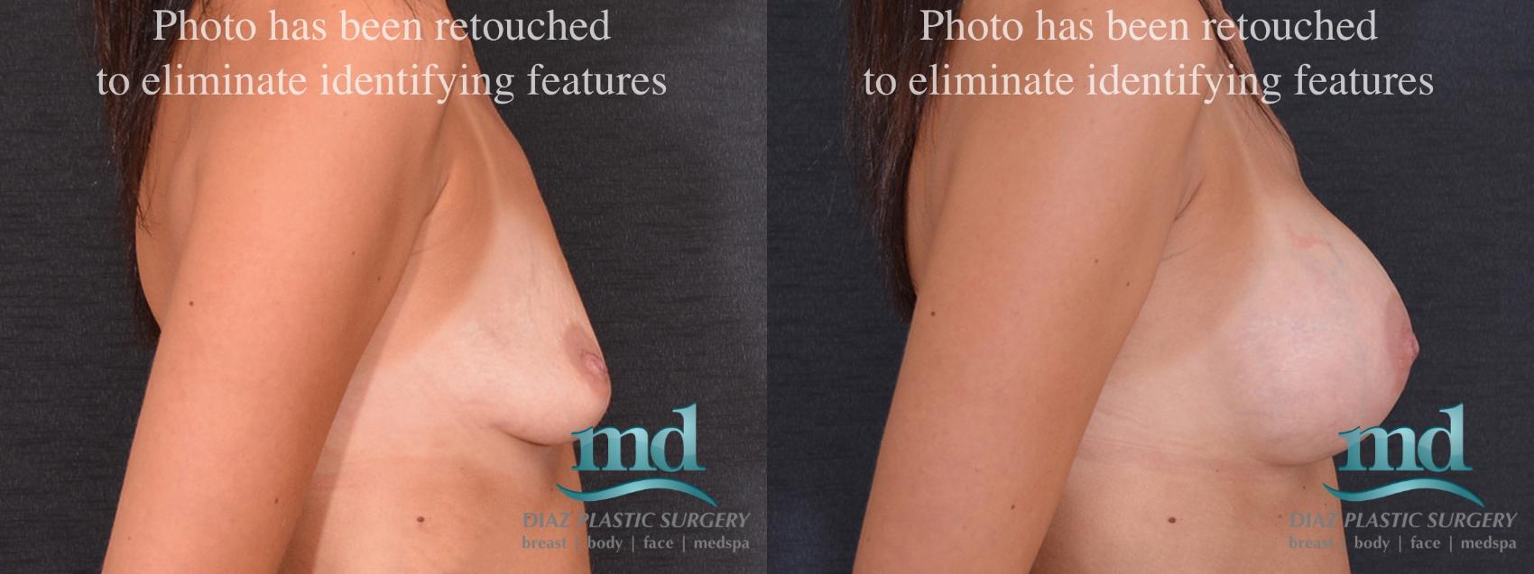 Before & After Breast Augmentation Case 52 View #3 View in Melbourne, FL