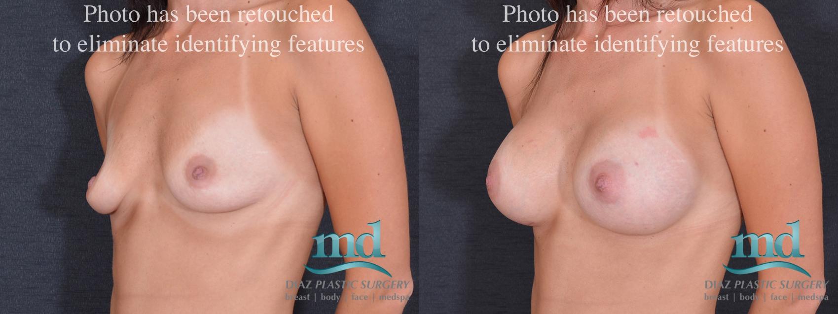 Before & After Breast Augmentation Case 52 View #4 View in Melbourne, FL