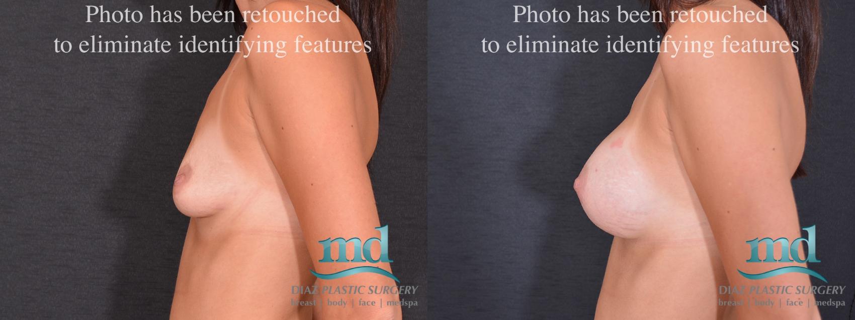 Before & After Breast Augmentation Case 52 View #5 View in Melbourne, FL