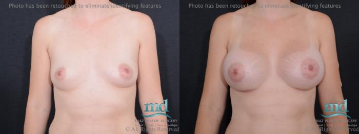Before & After Breast Augmentation Case 53 View #1 View in Melbourne, FL
