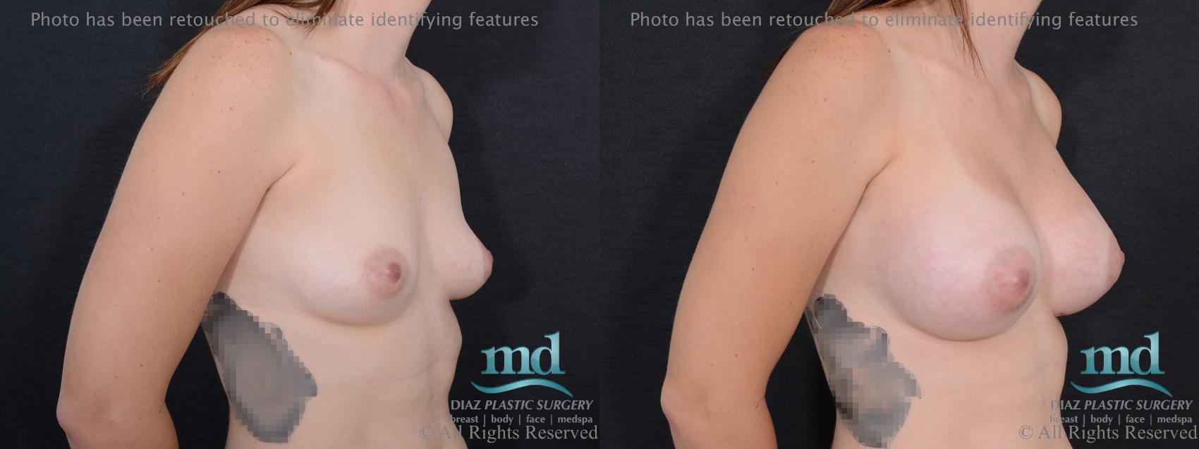 Before & After Breast Augmentation Case 53 View #2 View in Melbourne, FL