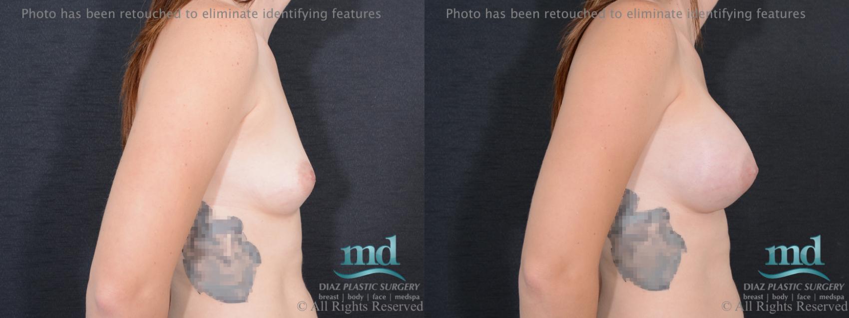 Before & After Breast Augmentation Case 53 View #3 View in Melbourne, FL